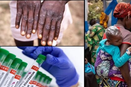 Mpox clade 1 variant: fast-spreading strain in india